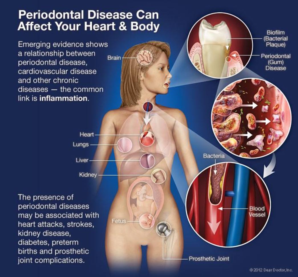 Periodontal disease can affect your heart body